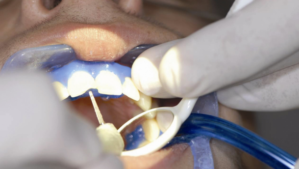 Preparazione di incisivo centrale con Laser Erbium Litetouch (Syneron)