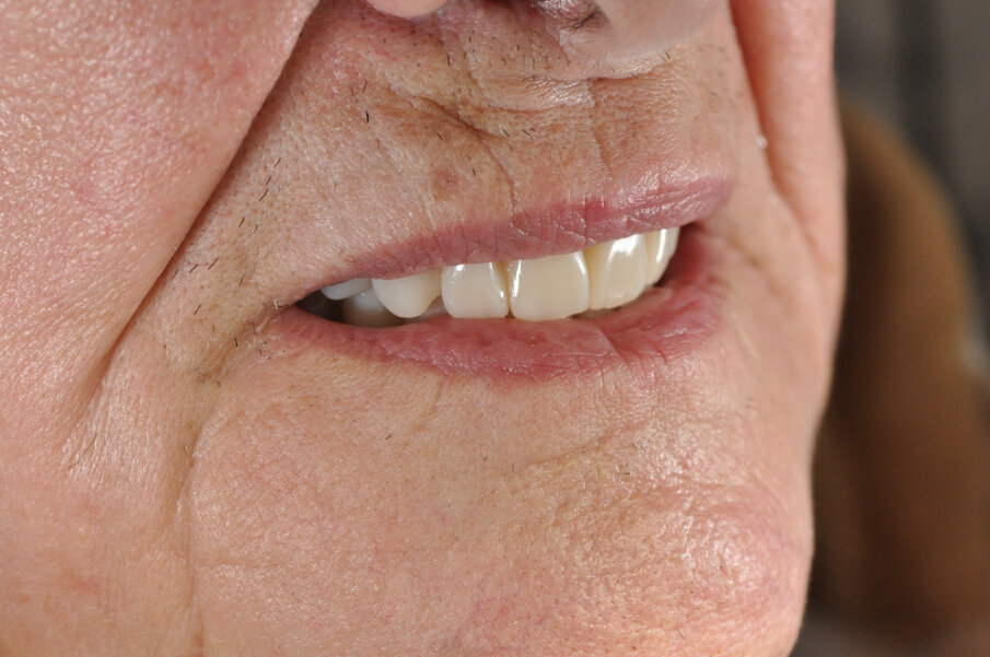 Fig. 13_Controllo a 4 settimane: dettaglio della morfologia e texture del gruppo frontale.