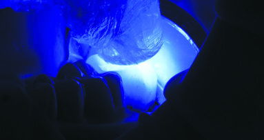 3M™ RelyX™ Ultimate Adhesive Resin  Cement – Posterior Crown