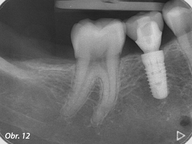 Definitivní náhrada v ústech pacientky.