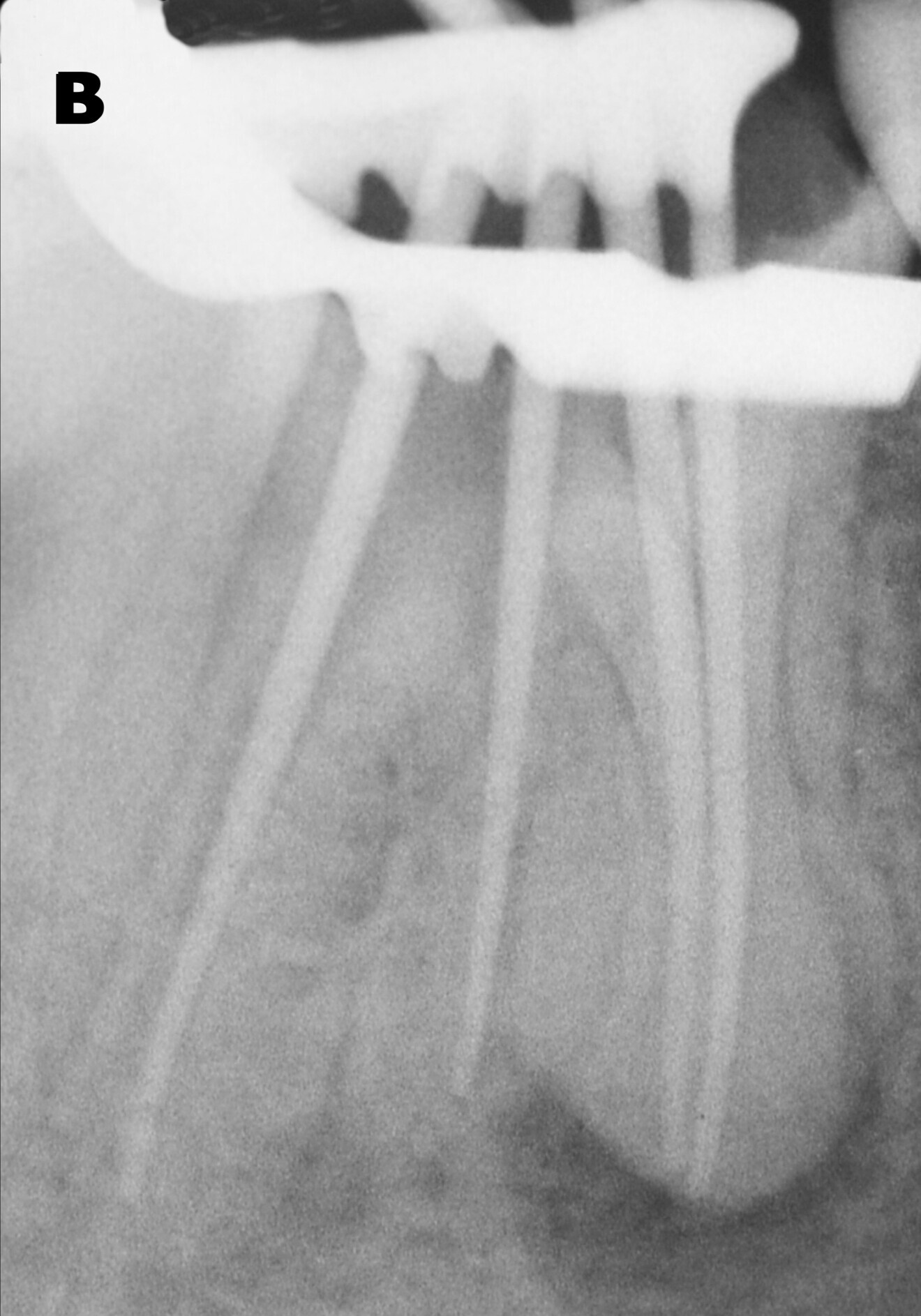 Fig. 2b: Check of the extension of the Master gutta-percha points (b).