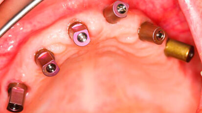 Nuova nanotecnologia per migliorare il ripristino osseo in pazienti dentali