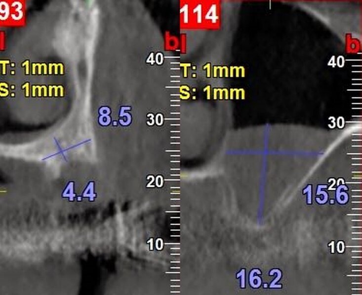 Fig. 3 - Sezioni CBCT pre-operatorie. La cresta ossea in corrispondenza della posizione 2.4 presentava uno spessore trasversale del mascellare di 8,5 mm e una distanza cresta ossea/pavimento cavità nasale di 4,4 mm mentre lo spessore della cresta in corrispondenza del pavimento del seno mascellare sinistro era inferiore ad 1 mm. Si noti la presenza nel seno mascellare di un mucocele (asintomatico).