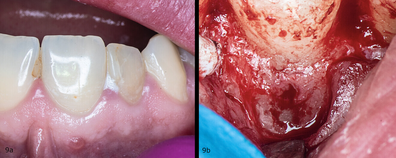 Figs. 9a & b: Clinical situation before the procedure (a) and after raising of the flap and perforation of the cortical bone (b).