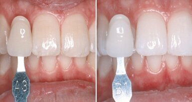 Online-Fortbildung thematisiert Erfolgsmodell Zahnaufhellung