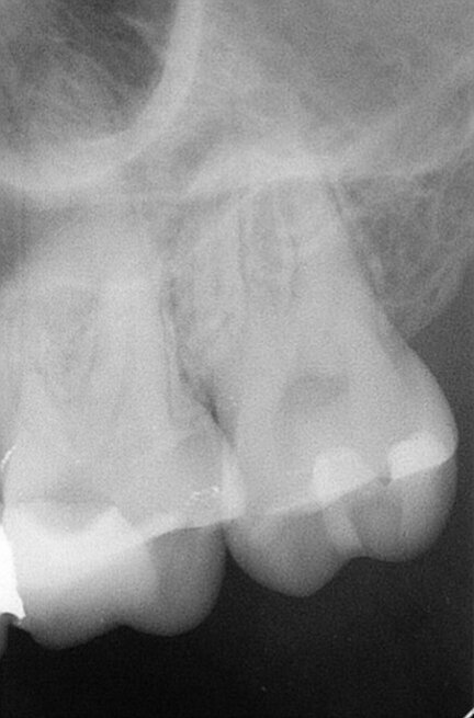 Fig. 2: Initial radiograph.