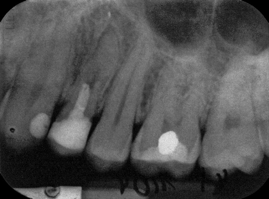 Case 2: Male (born
28 December 1980): Tooth 14
Fig. 4c: 16 January 2004 status.