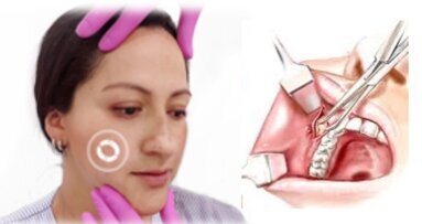 Datos importantes y riesgos de la bichectomía