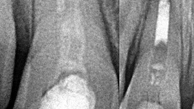 Revaskularizacija nekrotične pulpe u predelu apeksa zuba nezavršenog razvoja korena