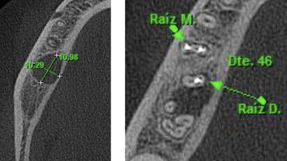 Figura 1. Inclinación de la raíz distal del primer molar inferior derecho hacia lingual. Ubicada aproximadamente a 10 mm de la cortical ósea vestibular, lo que hace imposible hacer el abordaje quirúrgico a través de microcirugía. Figura 1. Inclinación de la raíz distal del primer molar inferior derecho hacia lingual. Ubicada aproximadamente a 10 mm de la cortical ósea vestibular, lo que hace imposible hacer el abordaje quirúrgico a través de microcirugía.