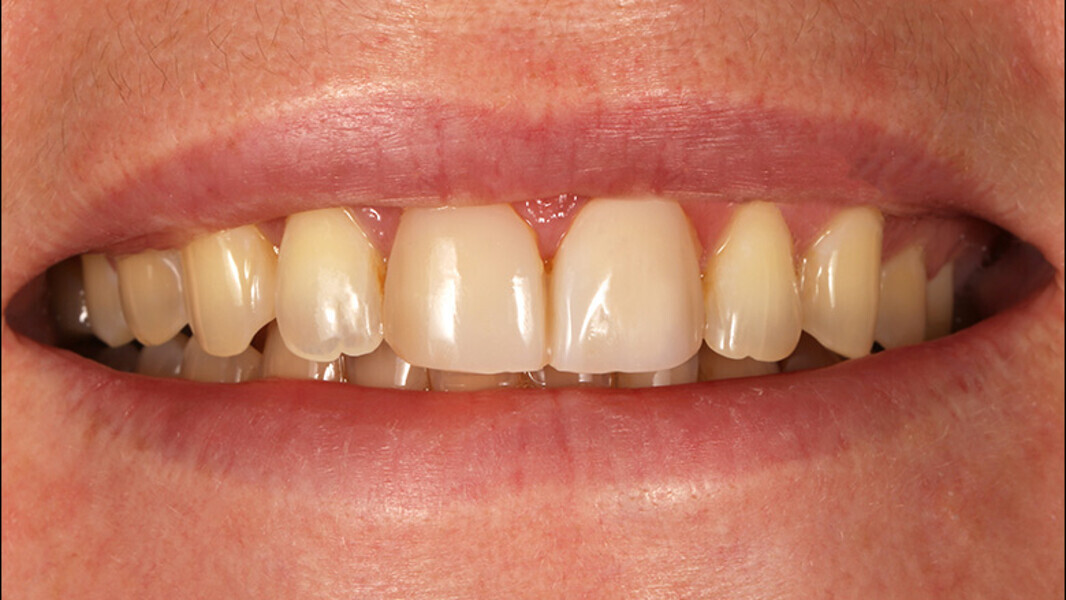 Fig. 4. El mock-up satisfizo las expectativas estéticas de la paciente.