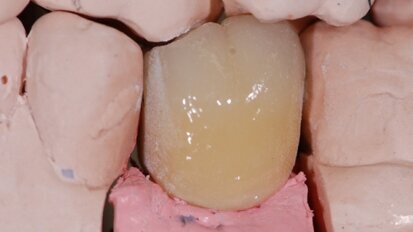 Algorytmy postępowania dla wykonywania indywidualnych rozwiązań protetycznych – część 1