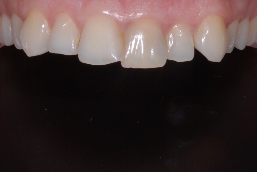 Fig. 17: Intra-oral maxillary frontal view before treatment.