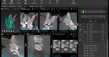 Korišćenje digitalnog softvera za efikasnu terapiju korenskih kanala