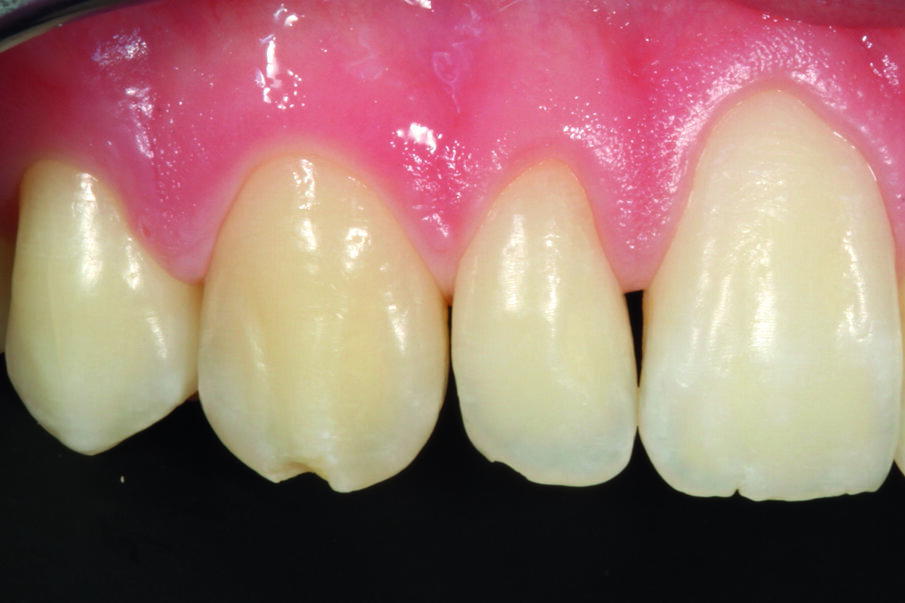 Afbeelding 12. Beginsituatie: incisaal chippen van element 13.