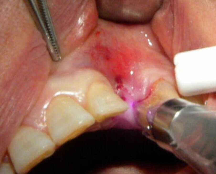 Fig. 10 - Caso clinico 3. Scopertura implantare: è possibile eseguire una precisa opercolectomia.