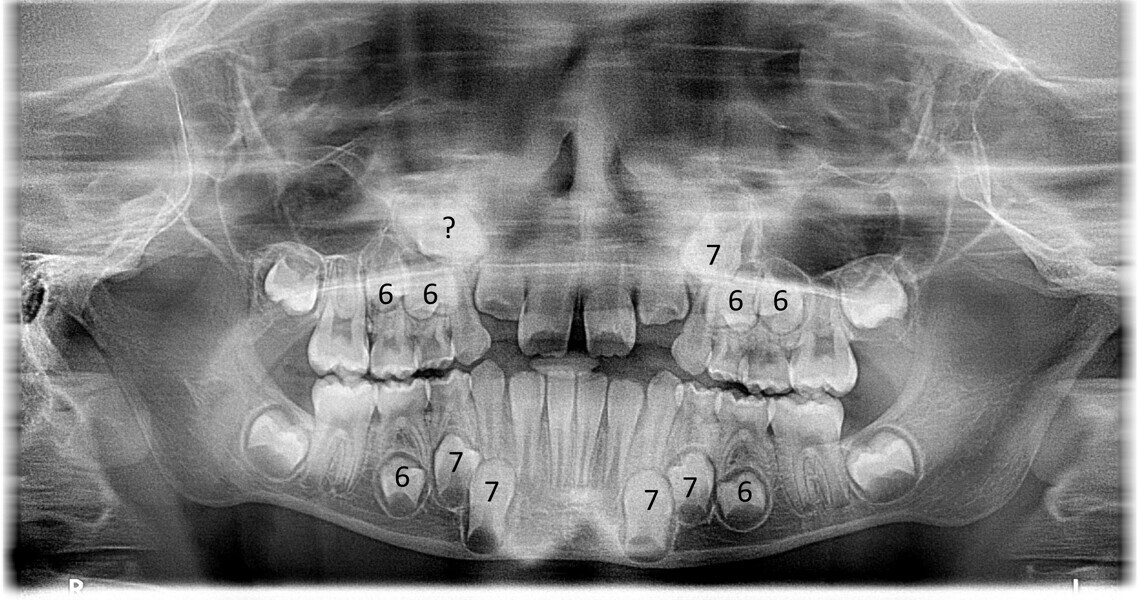 Fig. 3: Dental panoramic tomogram with Nolla index assignment.