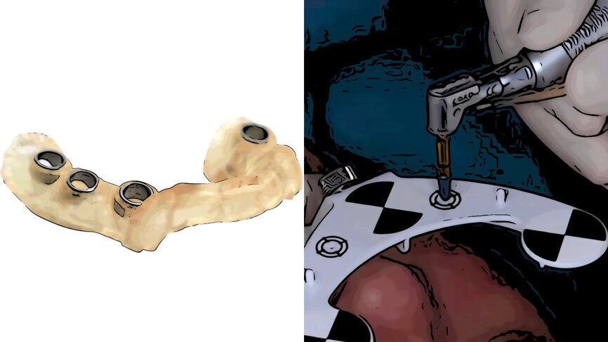 Figs. 4a et b : Guides chirurgical et dynamique.