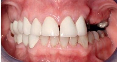 Konstrukcja mostu w odcinku przednim żuchwy