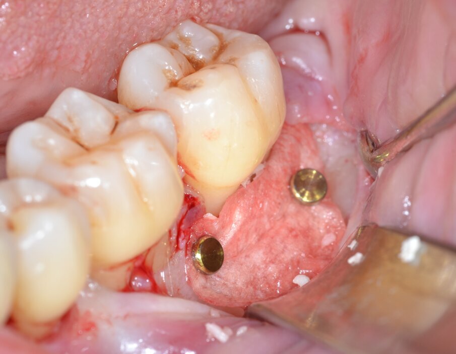 Fig. 11 - Stabilizzazione della membrana barriera mediante pins in titanio.