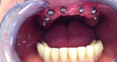 Złożone leczenie implantoprotetyczne bezzębia