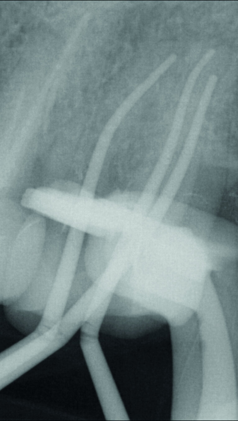 Fig. 10 : Radiographie des maîtres cônes pour confirmer la longueur de travail définie. 