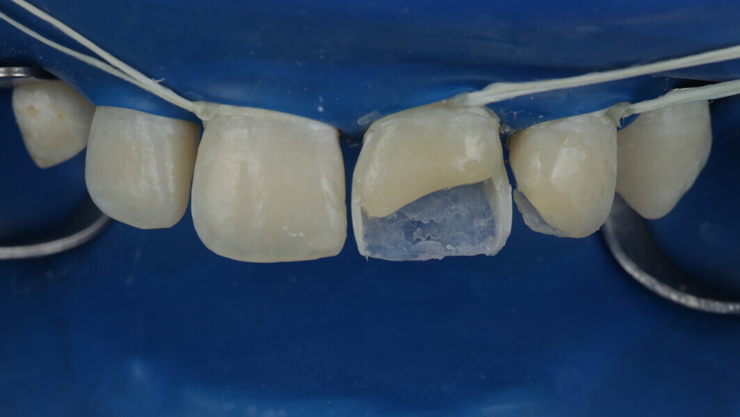 Fig 24: After interproximal build-up, the band and wedge were removed, leaving behind the scaffold for further layering.
