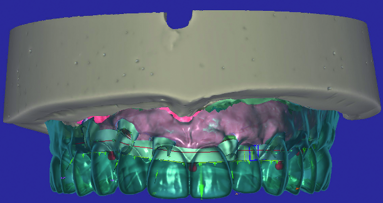 Removable prosthesis in digital times