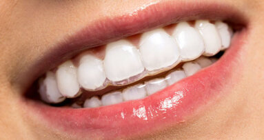 Denti, addio apparecchi. Sempre più persone scelgono gli aligner trasparenti delle celebrity