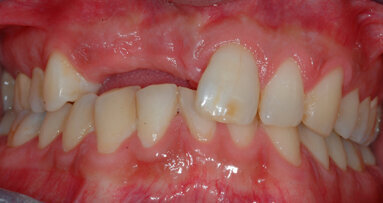 Espansione di cresta alveolare atrofica con strumentazione sonica senza lembo: tecnica FARE (Flapless Alveolar Ridge Expansion)