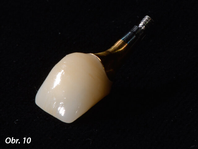 E.max korunka nacementovaná na abutmentu, pohled z vestibulární strany.