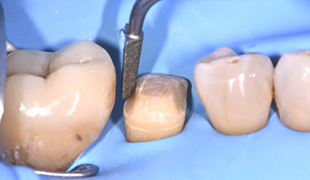 Fig. 7: Contouring. 