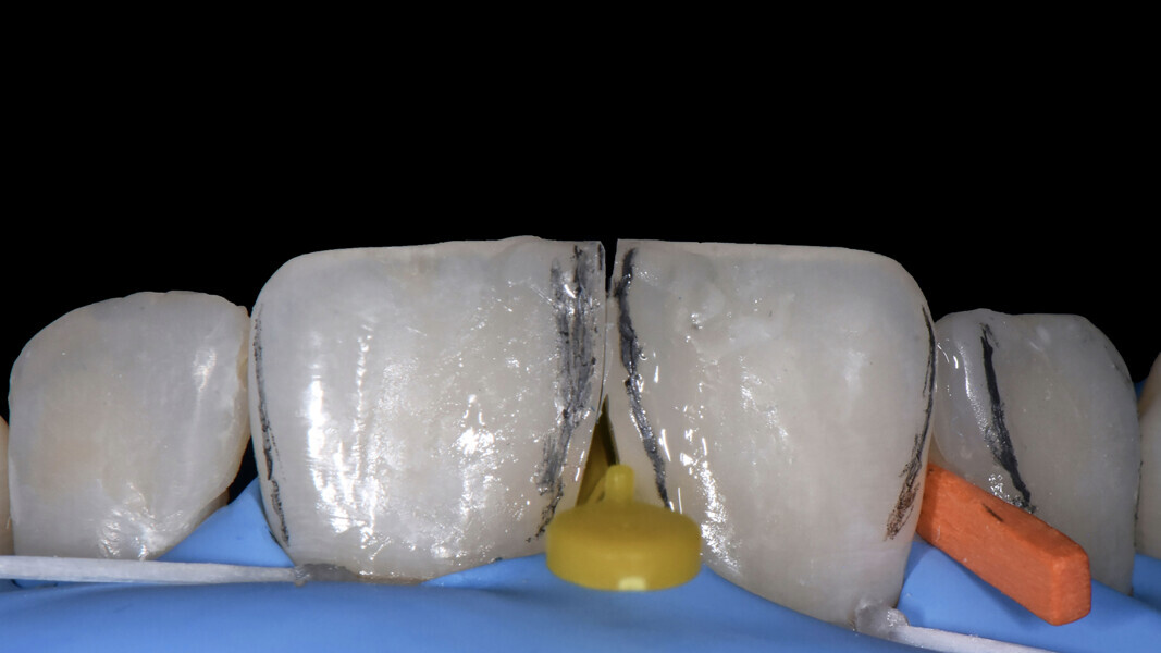 Fig. 12: Marked transition lines.