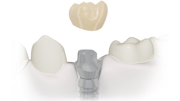 Realizzazione di un abutment implantare customizzato mediante CAD/CAM. Una soluzione specifica per ogni caso clinico