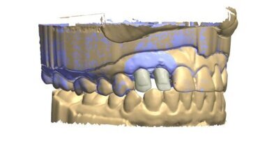 Odwzorowanie profilu wyłaniania implantu przy pomocy skanera wewnątrzustnego