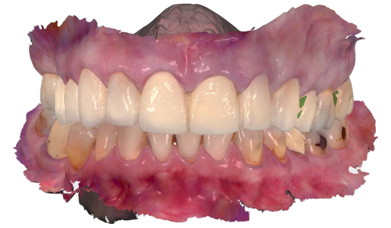 Fig. 10: Digital impression taken with the temporary restoration in place.