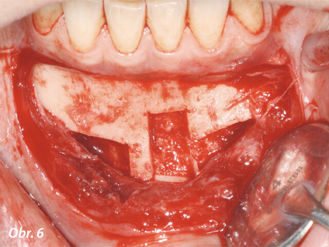 Kostní štěpy byly odebrány z bradové symfýzy a pevně zajištěny v místě transplantace chirurgickými šroubky.