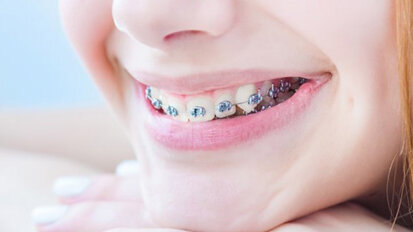 Gratiszahnspange: Einigung zwischen ÖZÄK und HV