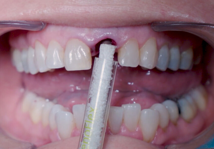 Fig. 14: Straumann XenoFlex being applied in labial gap.