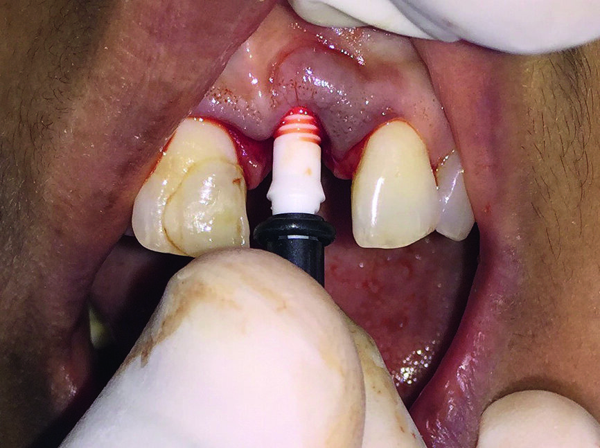 Figs. 3a–c : Implant ZiBone monobloc en zircone (Ø 4,0 mm, longueur 12,0 mm).