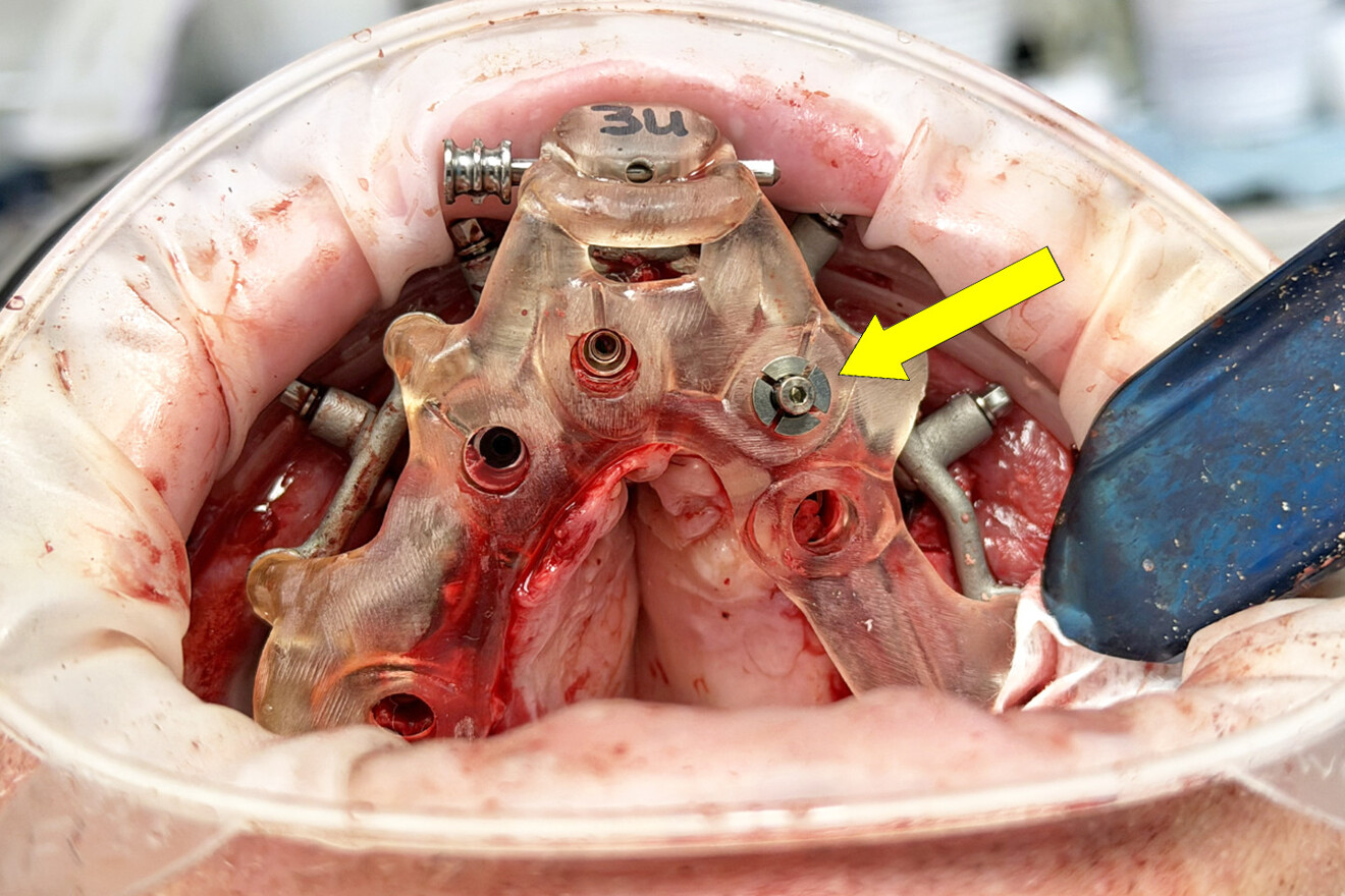 Fig. 21: Implant placement according to full-template guidance. Vertical anchor (yellow arrow) attached to improve guide stability.