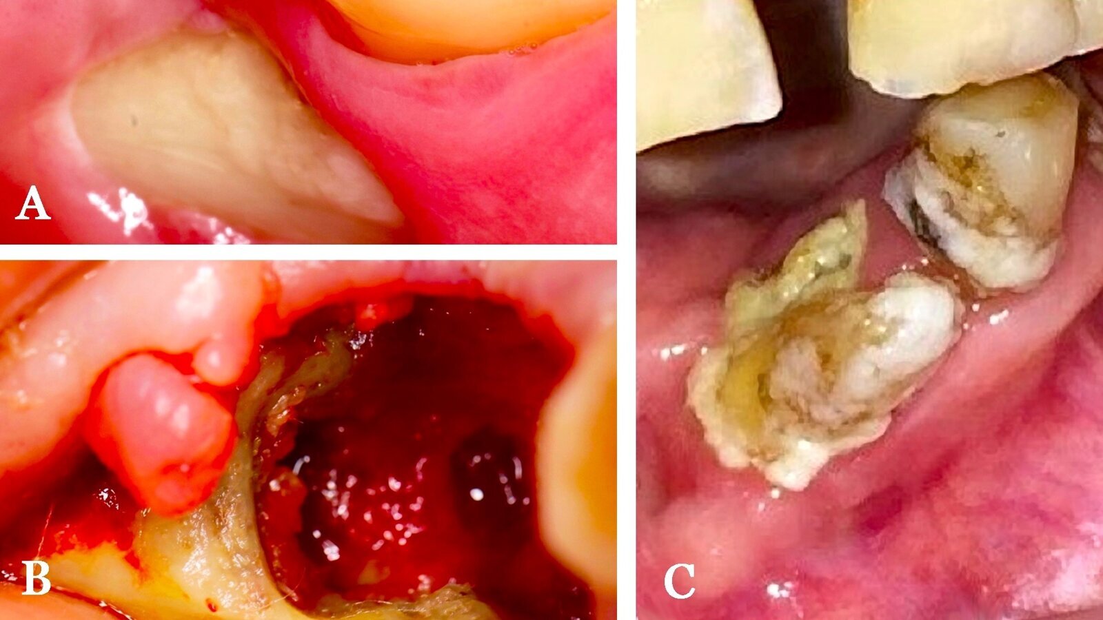 Estrategias para prevenir la osteonecrosis maxilar inducida por medicamentos