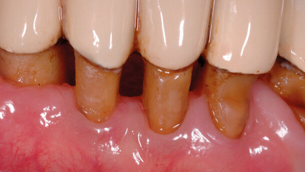 Ruolo delle nicchie ecologiche nell’eziologia dell’alitosi: la lingua tra le principali cause