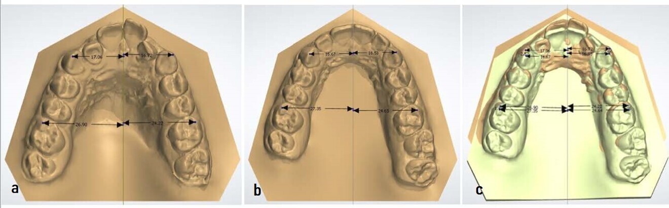 Figs. 22a–c: (a) Pretreatment model. (b) Post-treatment model. (c) Overlap of the two models, orange corresponding to the pretreatment model and green to the post-treatment model (images generated using 3Shape Dental System).