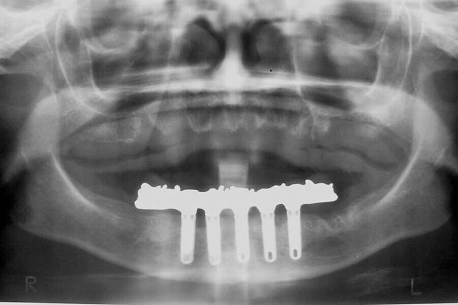 Fig. 5. Prótesis Híbrida inmediata y radiografía control con 6 años post-operatorio