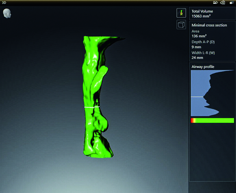 Fig. 3_Situazione finale della mandibola in posizione terapeutica. (OPTISLEEP applicazione in situ).