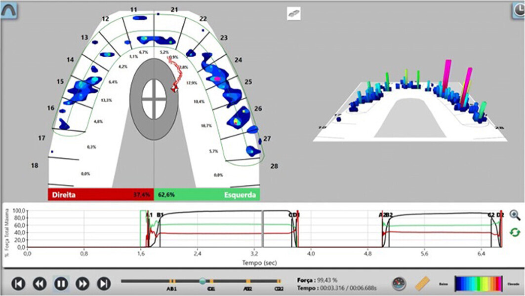 Fig. 16. Confirmación de la oclusión mediante tecnología T-scan.