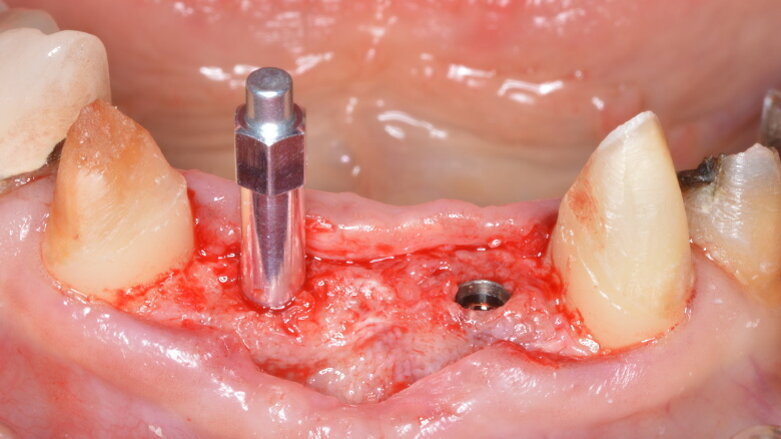 Three questions on insertion torque value and implant stability quotient