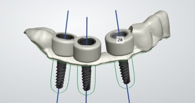 Prima operație dentară condusă de robot, a fost efectuată în China