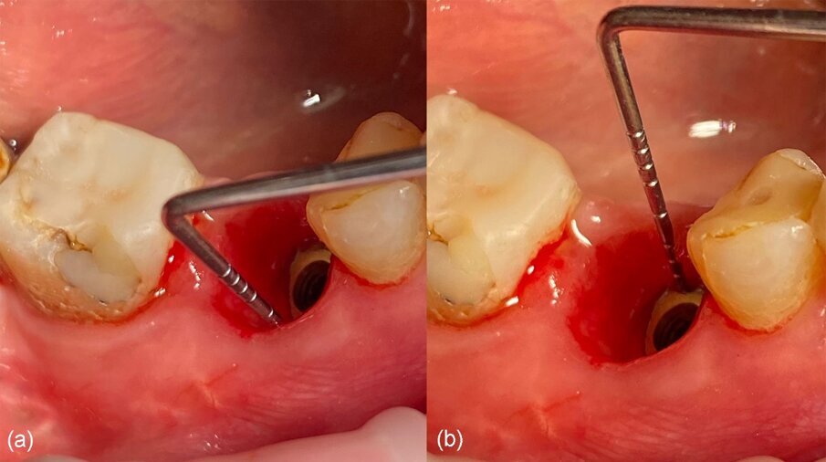 Fig. 23_Registrazione dell’altezza del tessuto molle sopra la piattaforma del moncone di connessione con una sonda parodontale.
